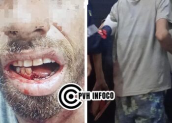 Acusado de Crime é Espancado a Pauladas e Tem Mandíbula Quebrada na Zona Sul”