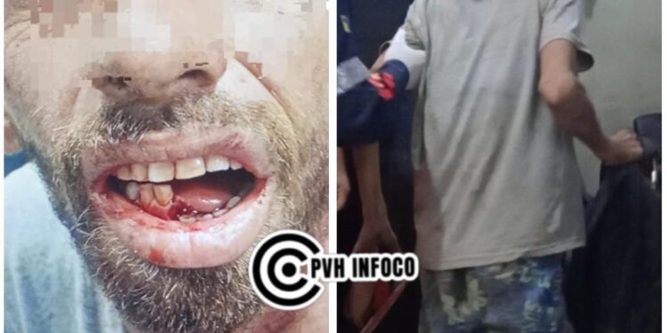 Acusado de Crime é Espancado a Pauladas e Tem Mandíbula Quebrada na Zona Sul”